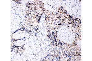 Anti-Eph receptor B3 antibody, IHC(P) IHC(P): Human Lung Cancer Tissue