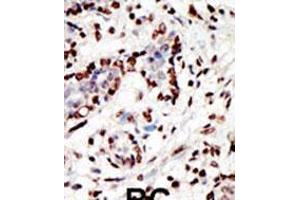 Formalin-fixed and paraffin-embedded human cancer tissue reacted with the primary antibody, which was peroxidase-conjugated to the secondary antibody, followed by AEC staining. (MLL/KMT2A anticorps  (C-Term))
