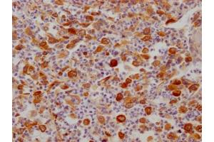 IHC image of ABIN7127486 diluted at 1:100 and staining in paraffin-embedded human lung cancer performed on a Leica BondTM system.