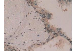 Detection of HDGF in Human Prostate Tissue using Polyclonal Antibody to Hepatoma Derived Growth Factor (HDGF) (HDGF anticorps  (AA 10-240))