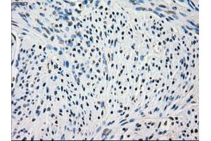 Immunohistochemical staining of paraffin-embedded Adenocarcinoma of colon tissue using anti-FRKmouse monoclonal antibody. (FRK anticorps)