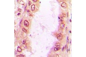 Immunohistochemical analysis of Sm-D2 staining in human lung cancer formalin fixed paraffin embedded tissue section. (SNRPD2 anticorps)