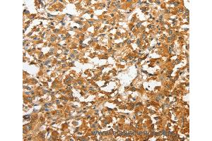 Immunohistochemistry of Human liver cancer using ANXA9 Polyclonal Antibody at dilution of 1:30