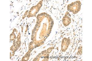 Immunohistochemistry of Human colon cancer using TSPAN13 Polyclonal Antibody at dilution of 1:35
