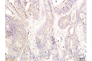 Formalin-fixed and paraffin embedded: human colon cancer tissue labeled with Anti-Dnmt-3-beta Polyclonal Antibody, Unconjugated (ABIN727623) at 1:600, followed by conjugation to the secondary antibody and DAB staining (DNMT3B anticorps  (AA 1-80))