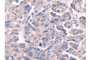 IHC-P analysis of Human Breast Cancer Tissue, with DAB staining. (Fibronectin anticorps  (AA 313-607))