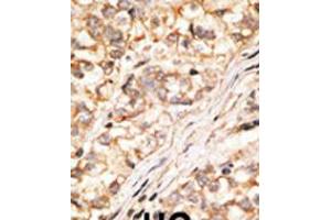 Formalin-fixed and paraffin-embedded human cancer tissue reacted with the primary antibody, which was peroxidase-conjugated to the secondary antibody, followed by DAB staining.