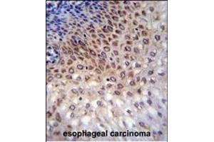 CCDC36 Antibody (C-term) (ABIN655696 and ABIN2845150) immunohistochemistry analysis in formalin fixed and paraffin embedded human esophageal carcinoma followed by peroxidase conjugation of the secondary antibody and DAB staining.