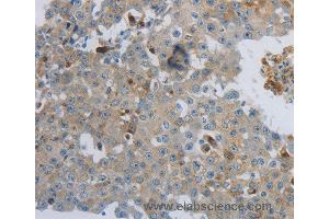 Immunohistochemistry of Human lung cancer using CKMT1A/CKMT1B Polyclonal Antibody at dilution of 1:100 (CKMT1A anticorps)
