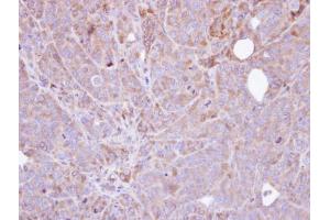 IHC-P Image Immunohistochemical analysis of paraffin-embedded SW480 xenograft , using Steroid sulfatase , antibody at 1:100 dilution. (STS anticorps)