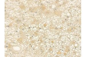 ABIN6261989 and ABIN6269005 at 1/100 staining human astrocytoma by IHC-P. (Metabotropic Glutamate Receptor 4 anticorps  (C-Term))