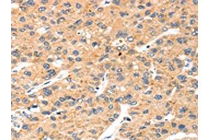 The image on the left is immunohistochemistry of paraffin-embedded Human liver cancer tissue using ABIN7192531(SLC8B1 Antibody) at dilution 1/20, on the right is treated with synthetic peptide. (SLC24A6 anticorps)