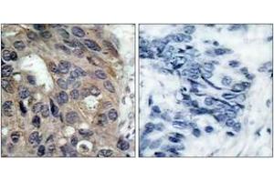 Immunohistochemistry analysis of paraffin-embedded human breast carcinoma, using Src (Phospho-Tyr529) Antibody. (Src anticorps  (pTyr530))