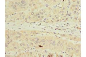 Immunohistochemistry of paraffin-embedded human liver cancer using ABIN7173011 at dilution of 1:100 (TMPRSS6 anticorps  (AA 98-301))
