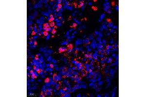 Immunofluorescence of paraffin embedded human lung cancer using AHSG (ABIN7073021) at dilution of 1:650 (400x lens) (Fetuin A anticorps)