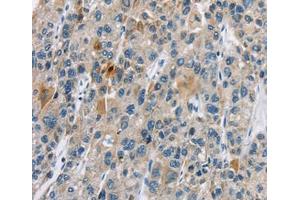 Immunohistochemical analysis of paraffin-embedded Human liver cancer tissue using at dilution 1/30. (CACNA2D1 anticorps  (Internal Region))