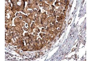 IHC-P Image PKD2 antibody [C1C3] detects PKD2 protein at cytosol and membrane on human breast carcinoma by immunohistochemical analysis.