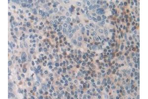 Detection of FDFT1 in Human Skin cancer Tissue using Polyclonal Antibody to Farnesyl Diphosphate Farnesyltransferase 1 (FDFT1)