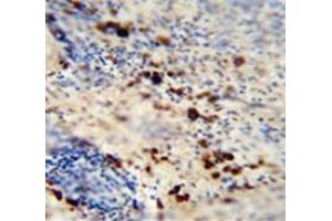 Immunohistochemistry analysis in human skin carcinoma (Formalin-fixed, Paraffin-embedded) using LCE1A  Antibody (C-term), followed by peroxidase conjugation of the secondary antibody and DAB staining. (LCE1A anticorps  (C-Term))