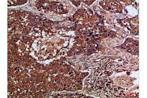 Immunohistochemical analysis of paraffin-embedded Human-lung-cancer, antibody was diluted at 1:100 (FLT4 anticorps  (AA 720-760))