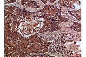 Immunohistochemical analysis of paraffin-embedded Human-lung-cancer, antibody was diluted at 1:100