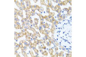 Immunohistochemistry of paraffin-embedded human liver injury using RIPK4 antibody (ABIN5974690) at dilution of 1/100 (40x lens).