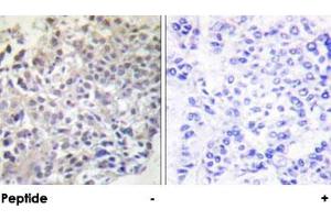 Immunohistochemical analysis of paraffin-embedded human breast carcinoma tissue using RAPGEF1 polyclonal antibody .