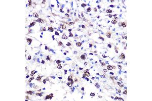 Immunohistochemistry of paraffin-embedded human liver cancer using NCL Rabbit pAb (ABIN6128392, ABIN6144411, ABIN6144412 and ABIN6221613) at dilution of 1:100 (40x lens). (Nucleolin anticorps  (AA 461-710))