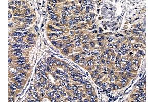 ABIN6258527 and ABIN6274787 at 1/100 staining human lung cancer and adjacent non-tumor tissue by IHC-P. (ABHD11 anticorps  (C-Term))
