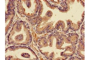 Immunohistochemistry of paraffin-embedded human prostate cancer using ABIN7164978 at dilution of 1:100 (PSMB4 anticorps  (AA 46-264))