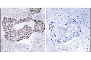 Immunohistochemistry analysis of paraffin-embedded human breast carcinoma tissue, using GATA1 (Ab-142) Antibody. (GATA1 anticorps  (AA 109-158))