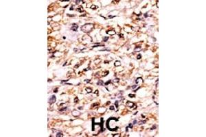 Formalin-fixed and paraffin-embedded human hepatocellular carcinoma tissue reacted with ESPL1 (phospho S1126) polyclonal antibody  which was peroxidase-conjugated to the secondary antibody followed by DAB staining.