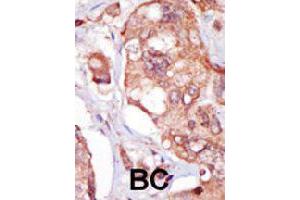 Formalin-fixed and paraffin-embedded human cancer tissue reacted with TNK1 polyclonal antibody  , which was peroxidase-conjugated to the secondary antibody, followed by AEC staining.