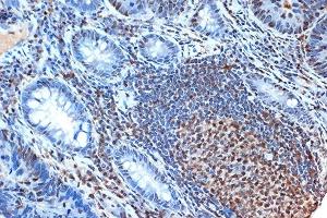 Immunohistochemistry of paraffin-embedded human colon carcinoma using FEN-1 Rabbit mAb (ABIN7267215) at dilution of 1:100 (40x lens). (FEN1 anticorps)