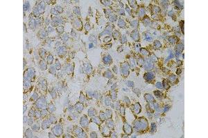 Immunohistochemistry of paraffin-embedded Human esophageal cancer using GNAO1 Polyclonal Antibody at dilution of 1:100 (40x lens).
