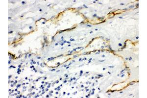 Anti- Aquaporin 1 Picoband antibody, IHC(P) IHC(P): Human Intestinal Cancer Tissue