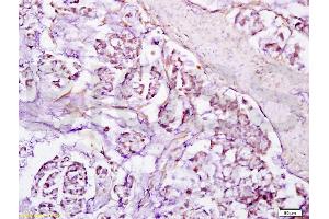 Formalin-fixed and paraffin embedded human gastric carcinoma labeled with Anti-SIRT1 Polyclonal Antibody, Unconjugated (ABIN729853) at 1:200, followed by conjugation to the secondary antibody and DAB staining (SIRT1 anticorps  (AA 101-200))