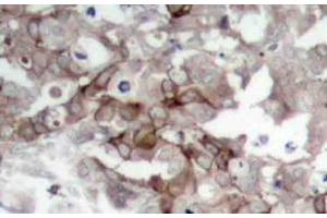 Immunohistochemistry analysis of Cortactin Antibody in paraffin-embedded human breast carcinoma tissue. (Cortactin anticorps)
