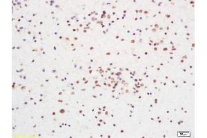 Formalin-fixed and paraffin embedded human glioma carcinoma labeled with Anti RCC1 Polyclonal Antibody, Unconjugated (ABIN700585) at 1:200 followed by conjugation to the secondary antibody and DAB staining