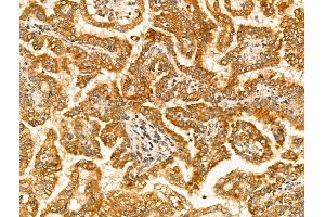 ABIN6265828 and ABIN6269033 at 1/100 staining Human kidney cancer by IHC-P. (TYR anticorps  (C-Term))