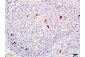 Formalin-fixed and paraffin embedded human lung carcinoma labeled with Anti-ADAMTS1 Polyclonal Antibody, Unconjugated (ABIN673404) at 1:200 followed by conjugation to the secondary antibody and DAB staining. (ADAMTS1 anticorps  (AA 851-967))