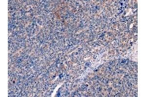 Detection of CK19 in Human Ovarian cancer Tissue using Monoclonal Antibody to Cytokeratin 19 (CK19) (Cytokeratin 19 anticorps  (AA 245-391))
