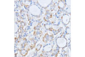 Immunohistochemistry of paraffin-embedded human thyroid cancer using RALGDS antibody (ABIN7269838) at dilution of 1:100 (40x lens).