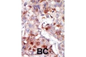 Formalin-fixed and paraffin-embedded human cancer tissue reacted with the primary antibody, which was peroxidase-conjugated to the secondary antibody, followed by AEC staining.