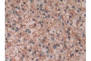 Detection of GaA in Human Renal cancer Tissue using Polyclonal Antibody to Glucosidase Alpha, Acid (GaA)
