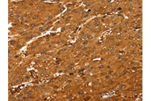 The image on the left is immunohistochemistry of paraffin-embedded Human liver cancer tissue using ABIN7189594(ABCC9 Antibody) at dilution 1/35, on the right is treated with synthetic peptide.