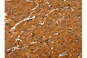 The image on the left is immunohistochemistry of paraffin-embedded Human liver cancer tissue using ABIN7189594(ABCC9 Antibody) at dilution 1/35, on the right is treated with synthetic peptide. (ABCC9 anticorps)
