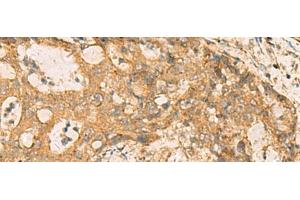 Immunohistochemistry of paraffin-embedded Human cervical cancer tissue using CNST Polyclonal Antibody at dilution of 1:70(x200) (CNST anticorps)