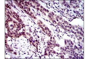 Immunohistochemical analysis of paraffin-embedded esophageal cancer tissues using CLGN mouse mAb with DAB staining. (Calmegin anticorps  (AA 249-405))