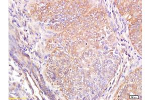 Formalin-fixed and paraffin embedded human breast carcinoma labeled with Anti Wnt6 Polyclonal Antibody, Unconjugated (ABIN762926) at 1:200 followed by conjugation to the secondary antibody and DAB staining (WNT6 anticorps  (AA 281-365))
